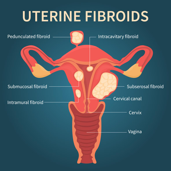 Uterine fibroids are tumors that grow into the wall of the uterus.